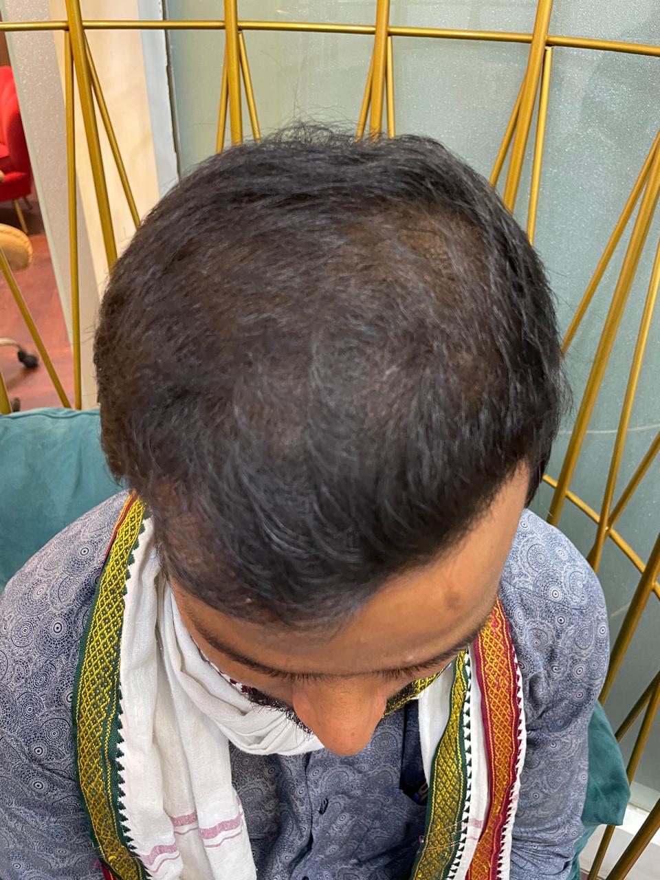 After - Hyper Hydra + PRP